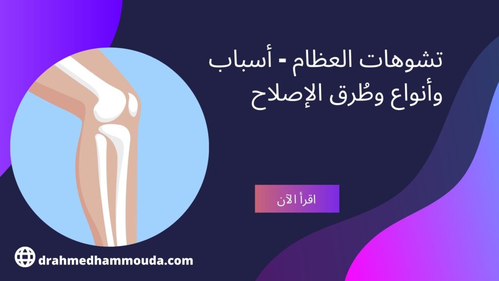 تشوهات العظام - أسباب وأنواع وطُرق الإصلاح