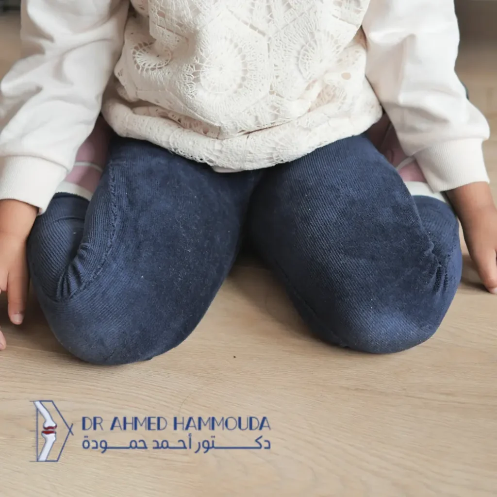هل تختفي آثار لين العظام عند الأطفال