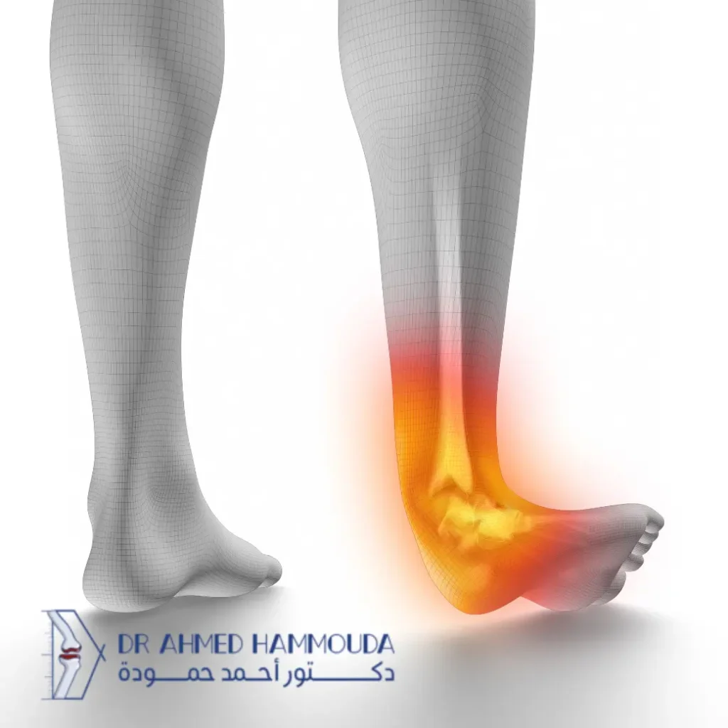 درجات التواء الكاحل
