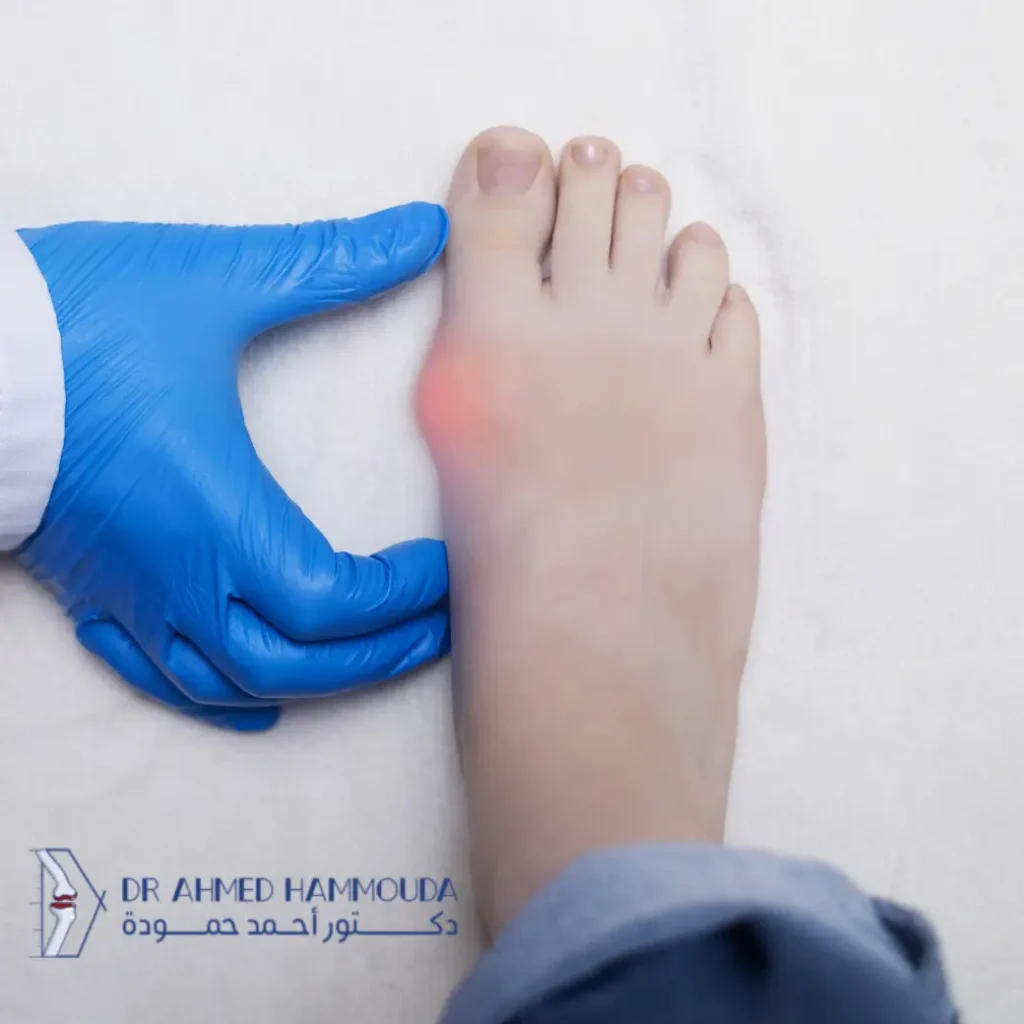 أعراض بروز عظمة القدم عند الأطفال