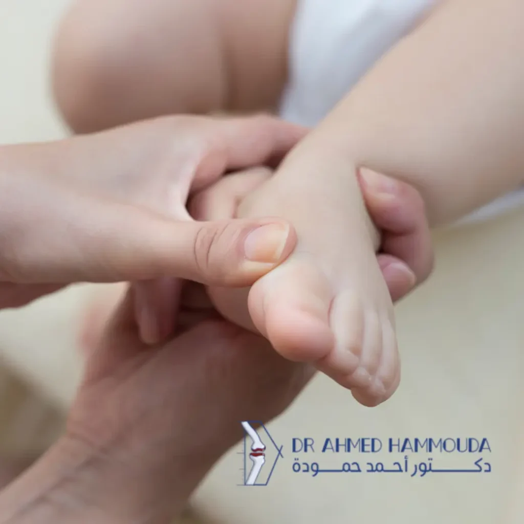 طريقة بونسيتي لعلاج حنف القدم
