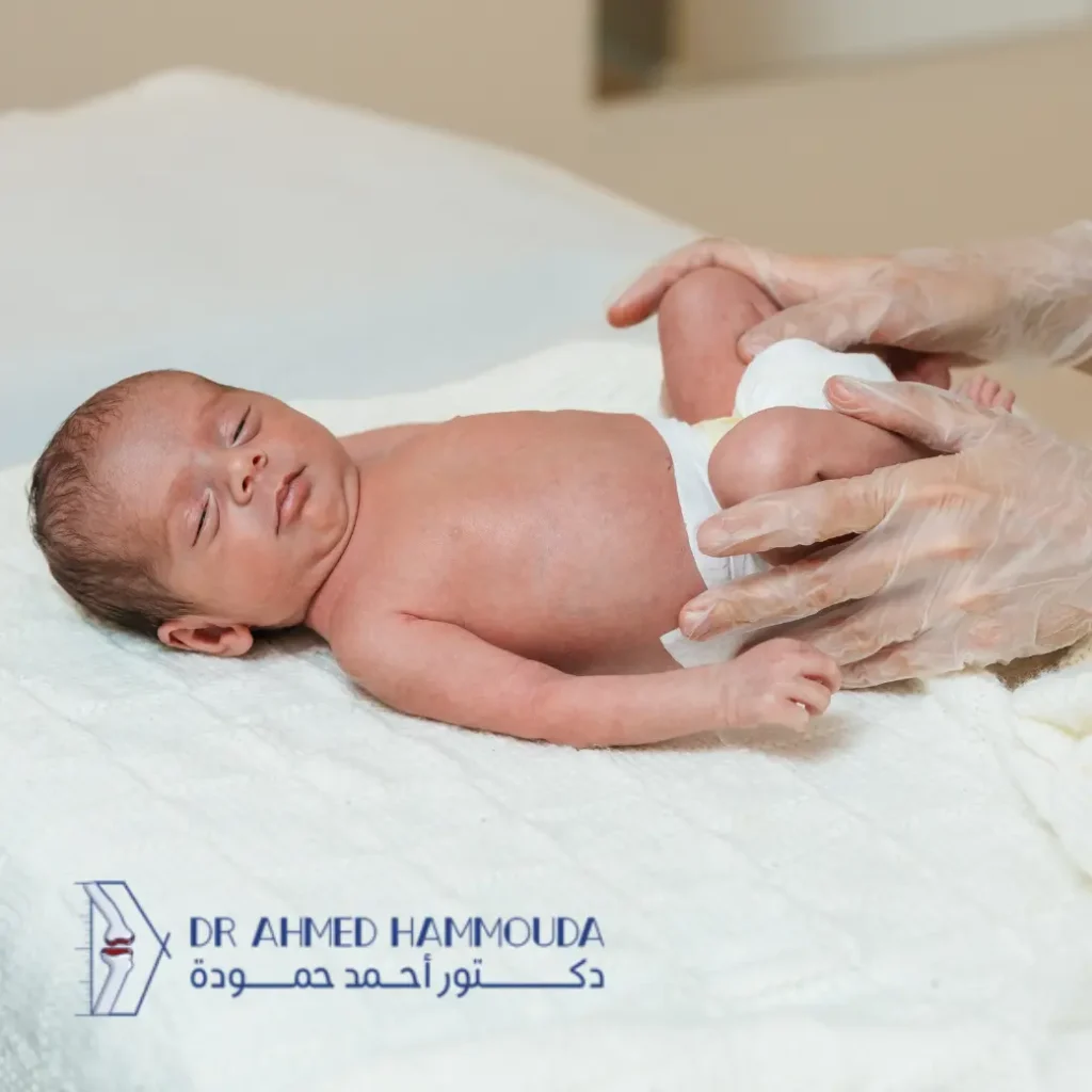 علاج خلع الورك الولادي