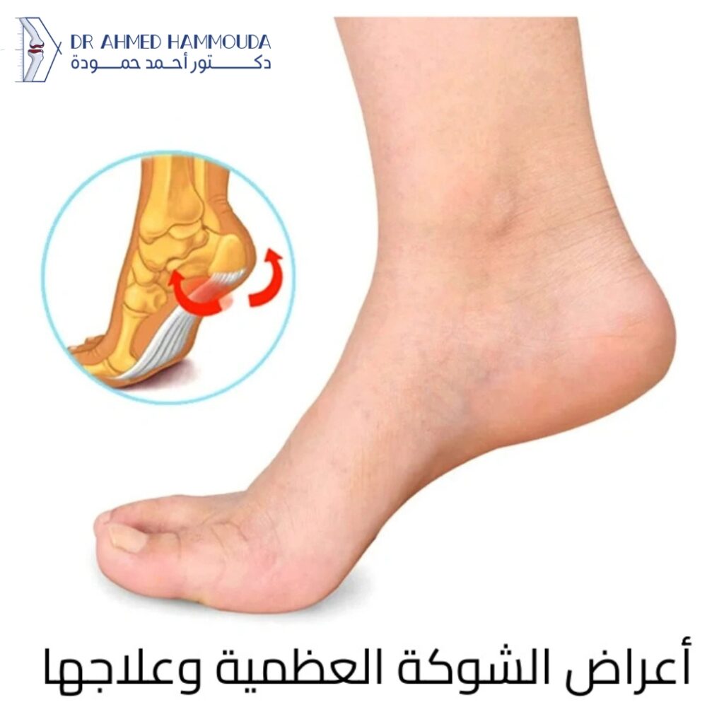 أعراض الشوكة العظمية وعلاجها