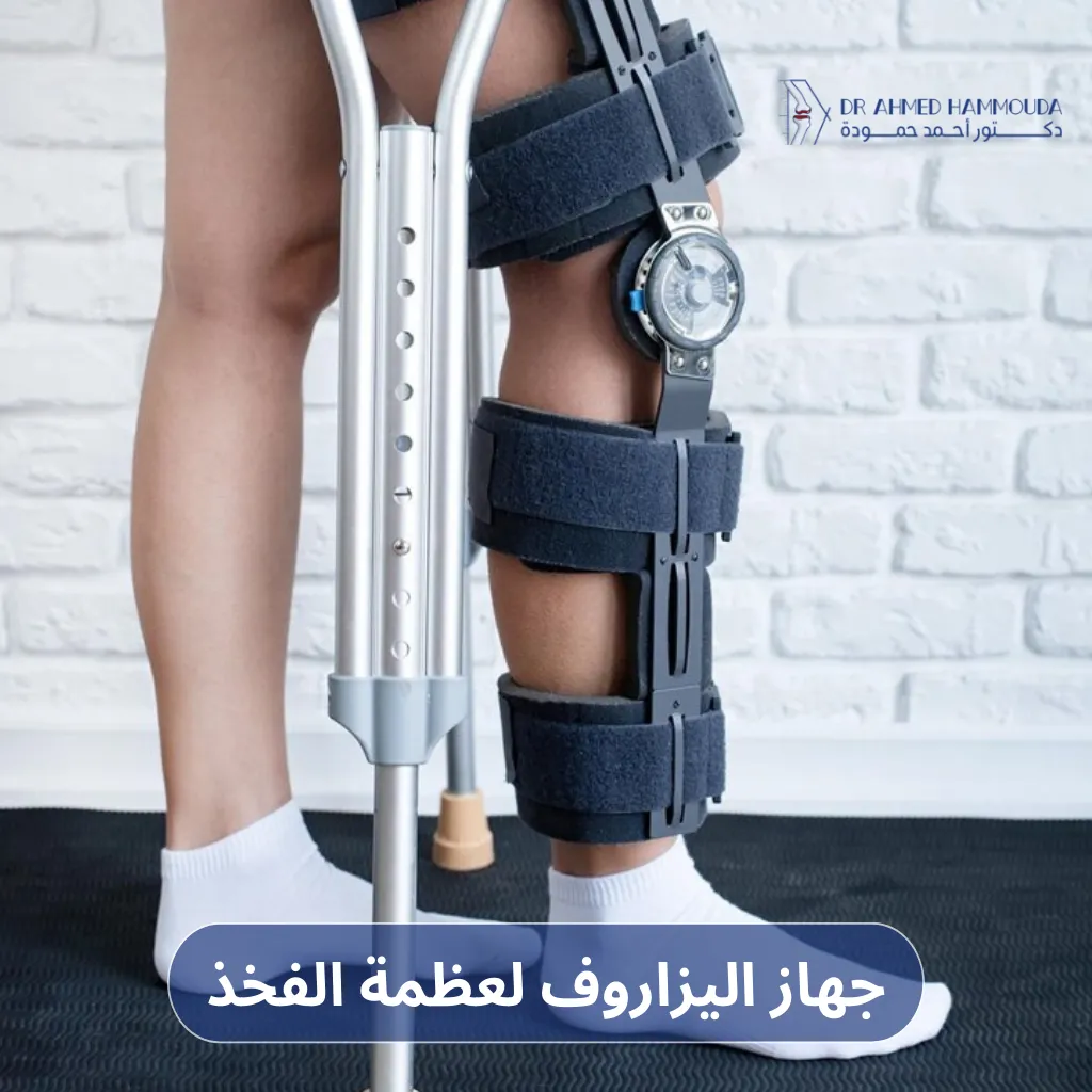 جهاز اليزاروف لعظمة الفخذ